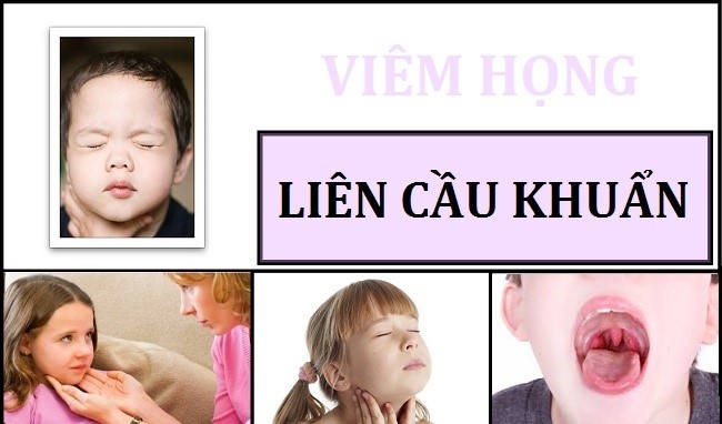 Viêm họng do liên cầu khuẩn - Hình ảnh minh họa